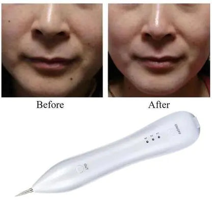 Mole Removal Pen – Professional Beauty Needle Device - Aurynaz